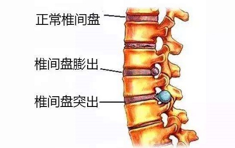 陈振龙：肾主骨生髓，肾气亏虚是否影响脊柱？