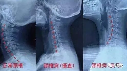 陈振龙：颈椎生理曲度变直，源于压迫，老拳师马步桩对其恢复作用！